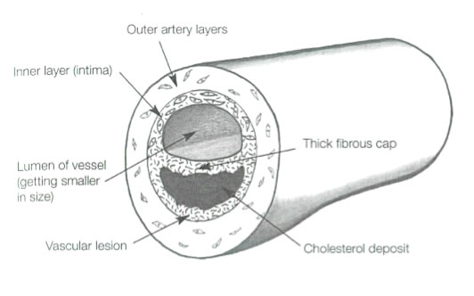 Vascular disease introduction graph 4